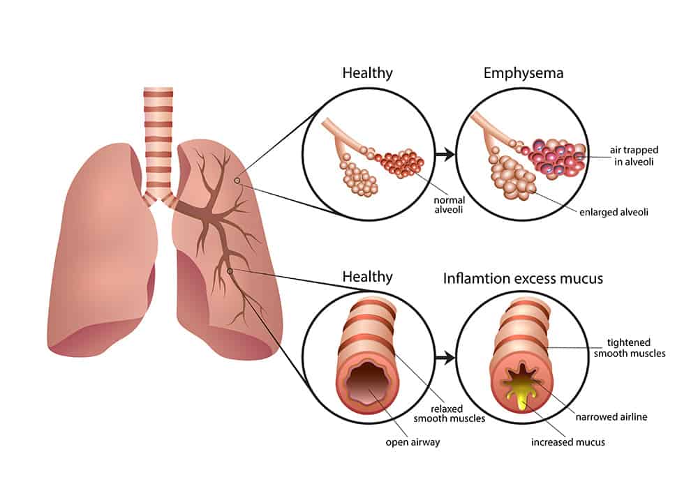 pulmonary conditions information graphic
